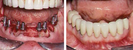 Jaw Bone Cancer Treatment in India